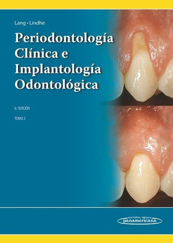 Periodontología Clínica E Implantología Odontológica: Tomo 2 [Hardcover] Lindhe, Jan and Lang, Niklaus P
